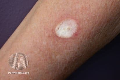 pinnacleskin.com /treatments/cryosurgery Carousel 1 Image 5