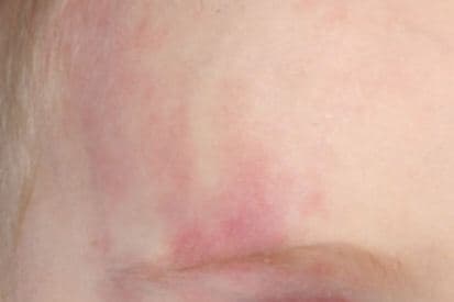 example-of-a-birthmark