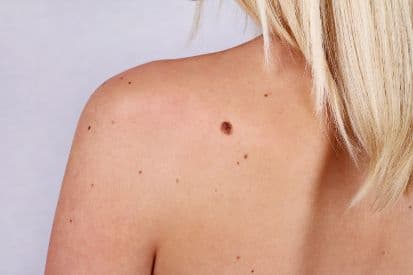 pinnacleskin.com /treatments/skin-cancer-screenings-and-total-body-skin-exams Carousel 1 Image 3