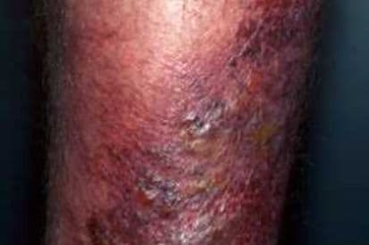 erysipelas-on-leg