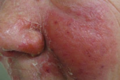 erysipelas-on-face