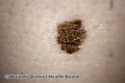 Melanoma-1