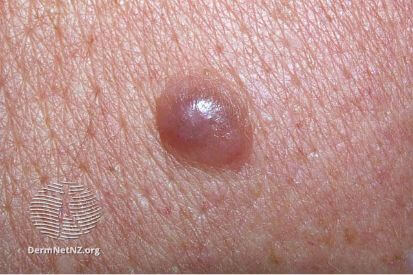 melanoma1-WatermarkedWyJXYXRlcm1hcmtlZCJd